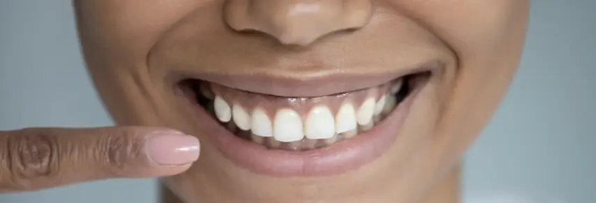 gummy smile treated with Botox