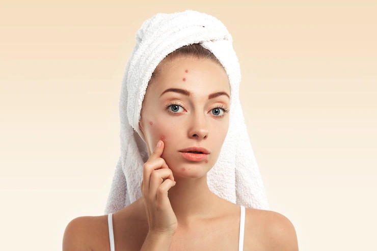 Battling Acne: 5 Effective Cosmetic Treatments