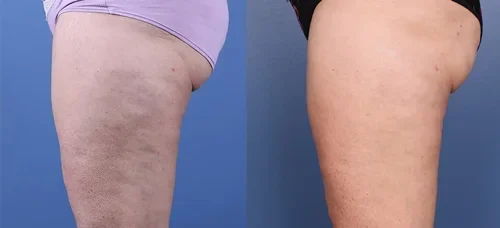 Morpheus8-thighs-before-and-after