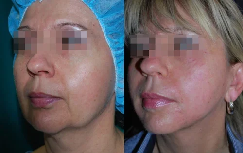 Skin-tightening-morpheus8-before-and-after-pictures