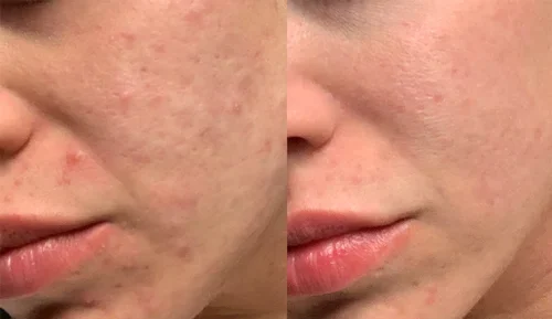 Morpheus8-acne-scars-before-and-after