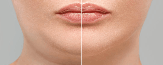 Botox For Jowls - Treatment, Before and After, Alternative, Costs