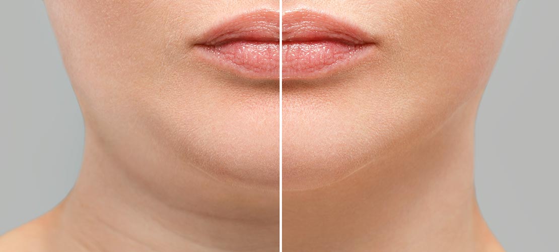 Botox For Sagging Jowls Before And After SA