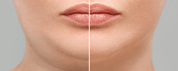 Botox For Jowls Treatment Before And After Alternative Costs