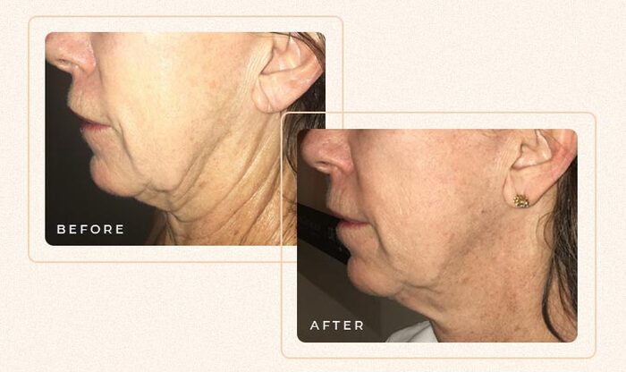 botox for sagging jowls before and after