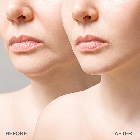 Botox for Sagging Jowls Before and After