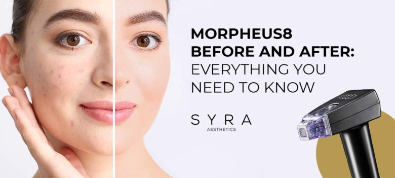 Morpheus8 Before and After: Everything You Need to Know