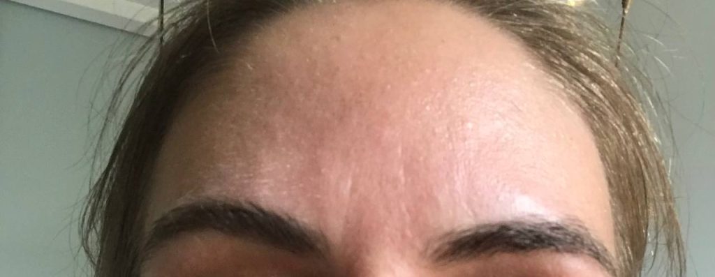 Vertical Dark Line on Forehead