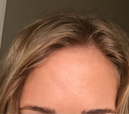 Vertical Depression Lines on Forehead 