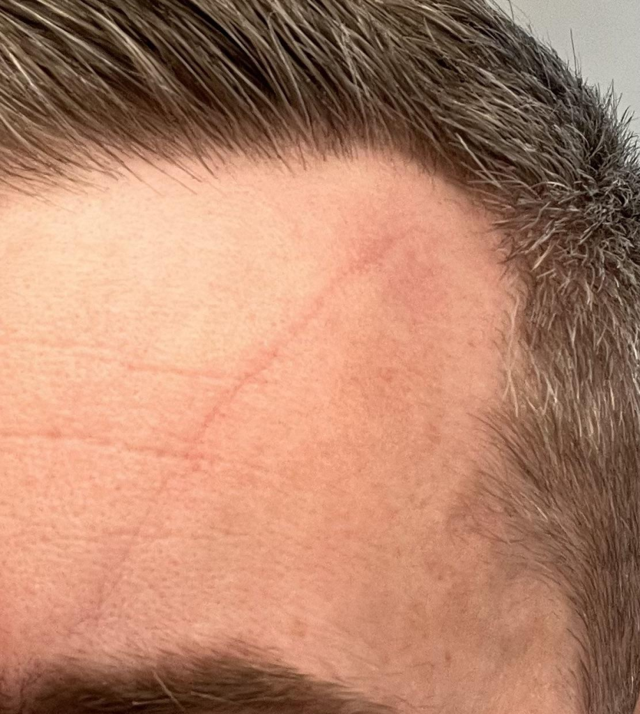 Vertical Lines On Forehead Sleeping 