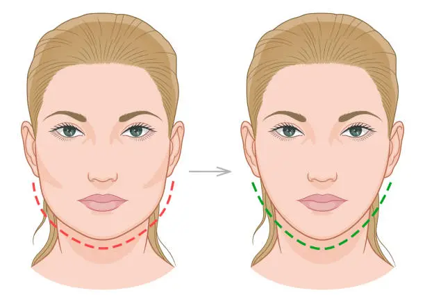 What-To-Expect-In-A-Jawline-Filler-Procedure