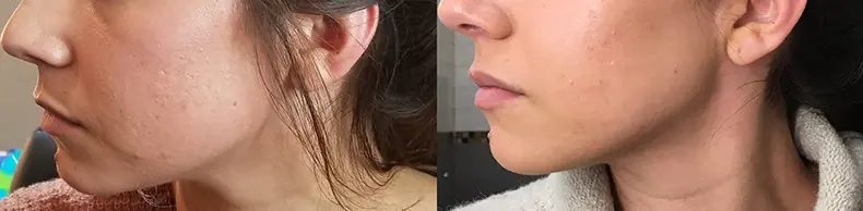 botox for jawline before and after