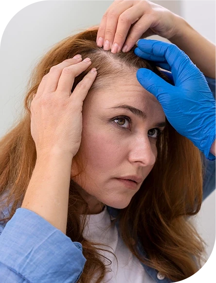 microneedling-prp-hair-treatment
