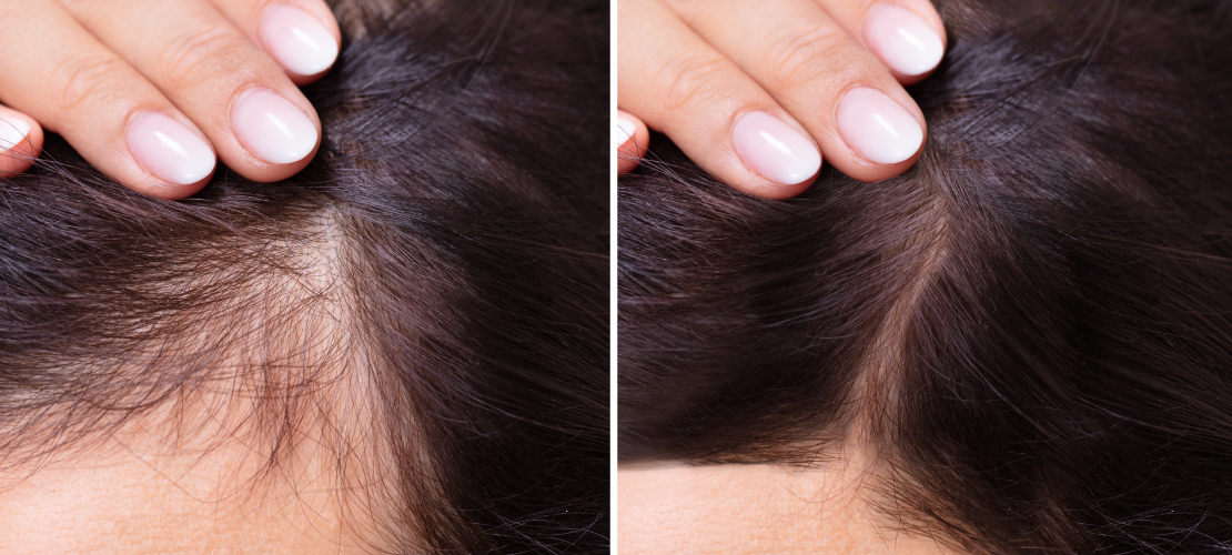Successful Hair Restoration Treatment:PRP Hair Before and After - Blog |  SYRA Aesthetics™ Med Spa