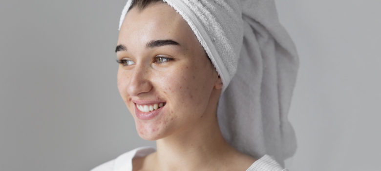 best acne dark spot treatment