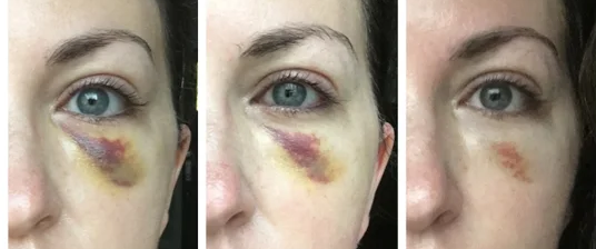 Bruising Under the Eye After Cheek Filler 