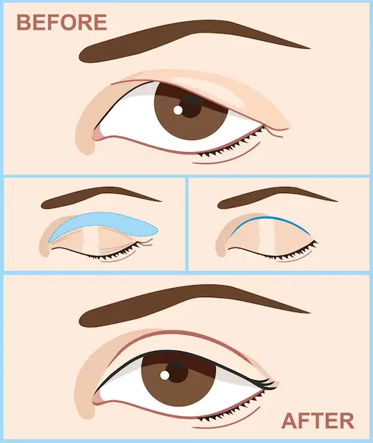 eyelid-before-after