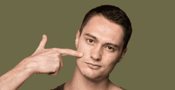 Does Dermaplaning Cause Acne