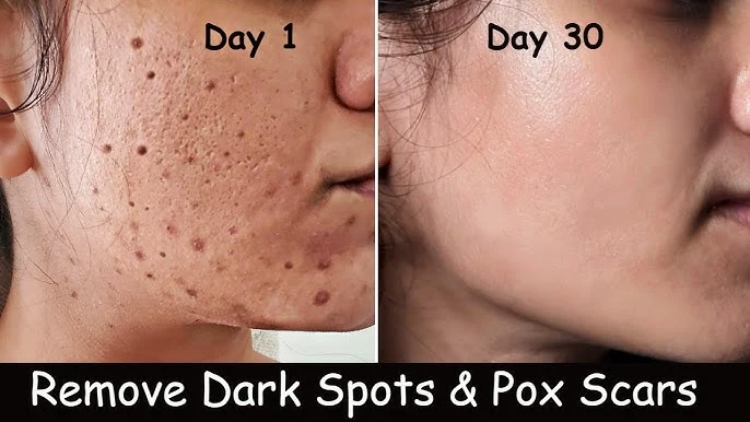 Microneedling Chicken Pox Scars Before And After