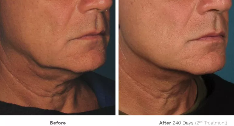 before_after_ultherapy_results_under-chin35