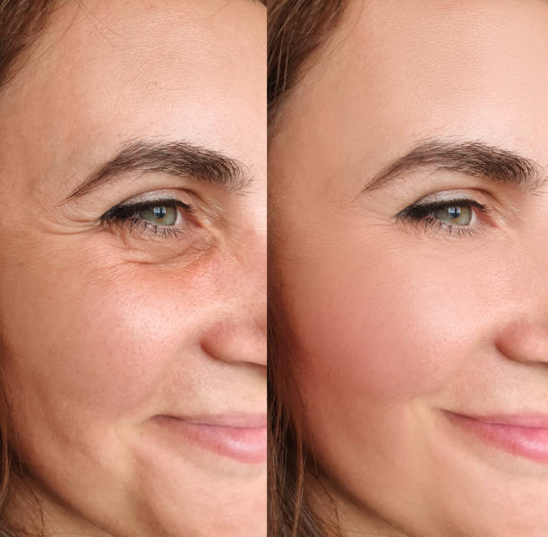 woman face wrinkles before and after treatment collage