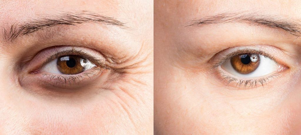 Crows Feet Botox Before And After Treatment