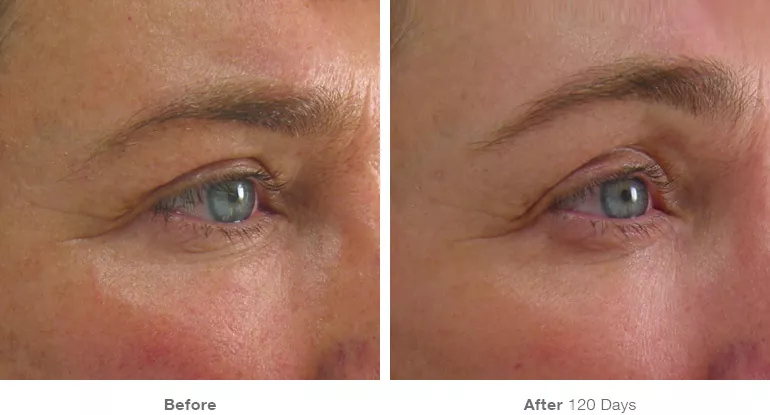 ultherapy_before_after_brow