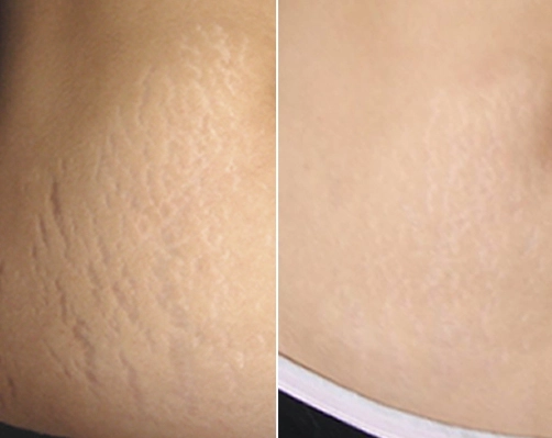 microneedling-for-stretch-marks-before-after