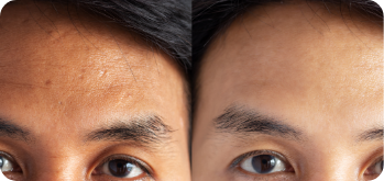 forehead botox before and after