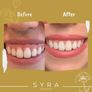 lip flip before and after