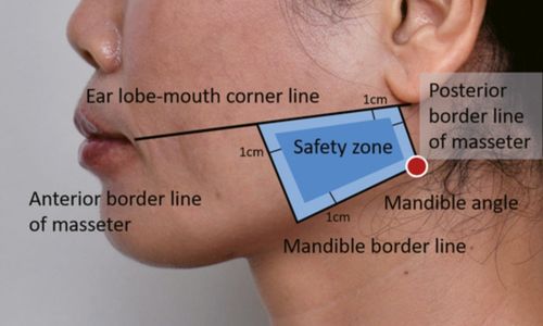 Masseter Botox injection sites