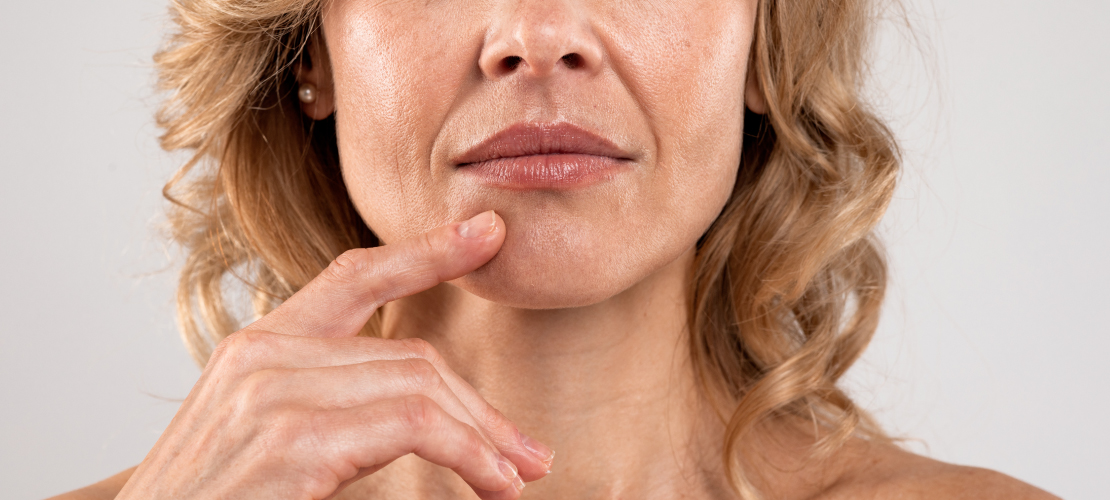 woman having Nasolabial Folds