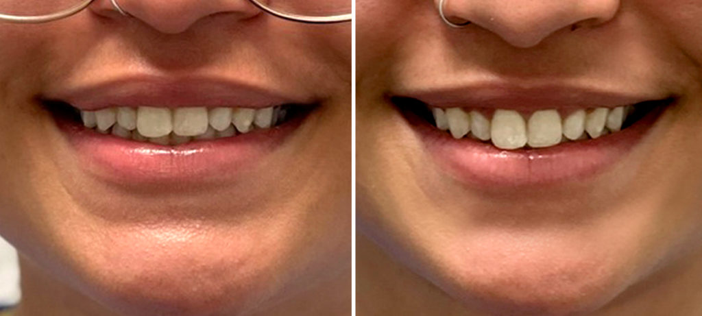 Botox-For-Gummy-Smile-Blog-v2.1