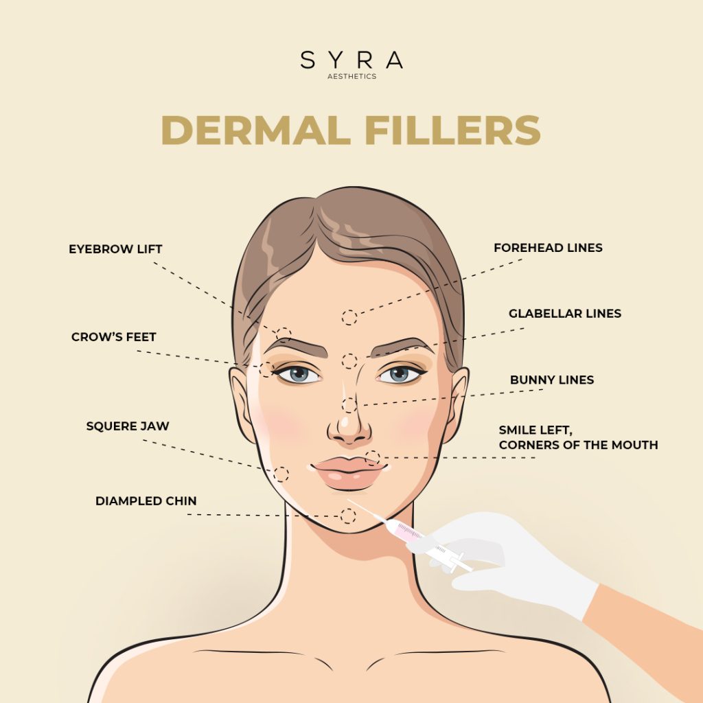 dermal fillers treatable areas