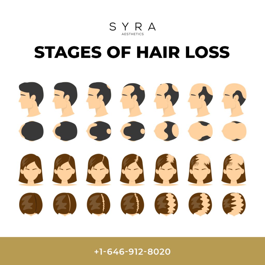 stages of hair loss