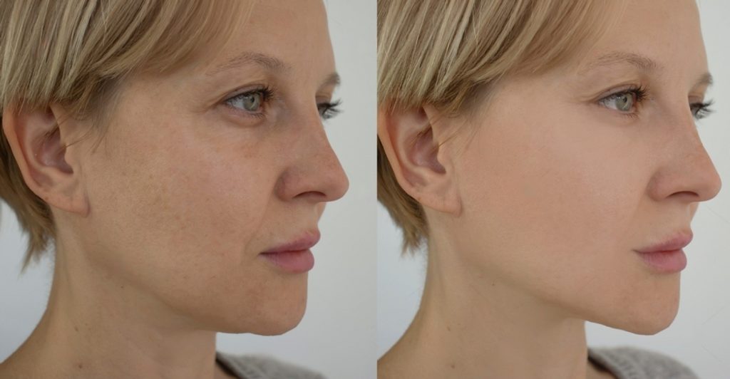 Cheek Fillers Before and After