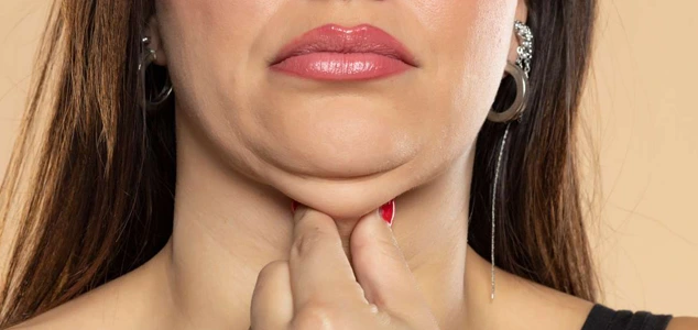 what causes a double chin