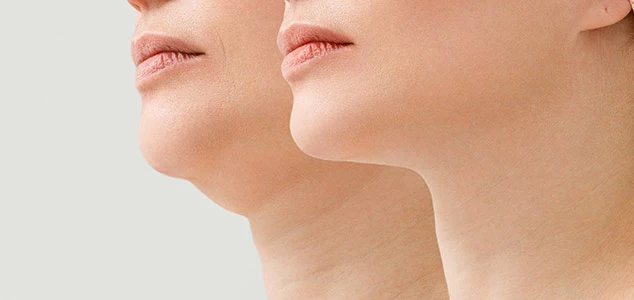 double chin removal non surgical