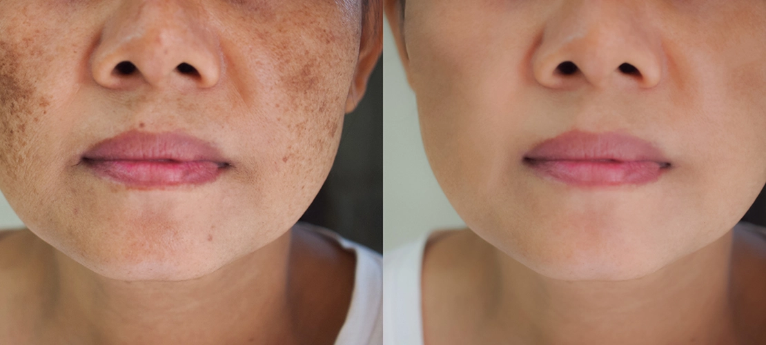 How To Get Rid of Age Spots