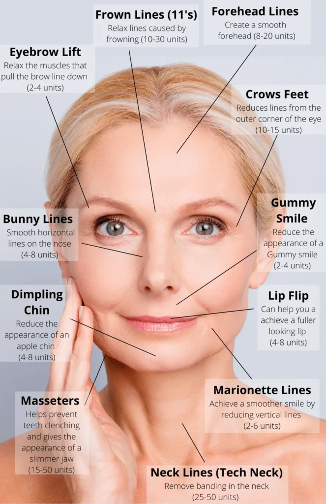 botox areas on the face
