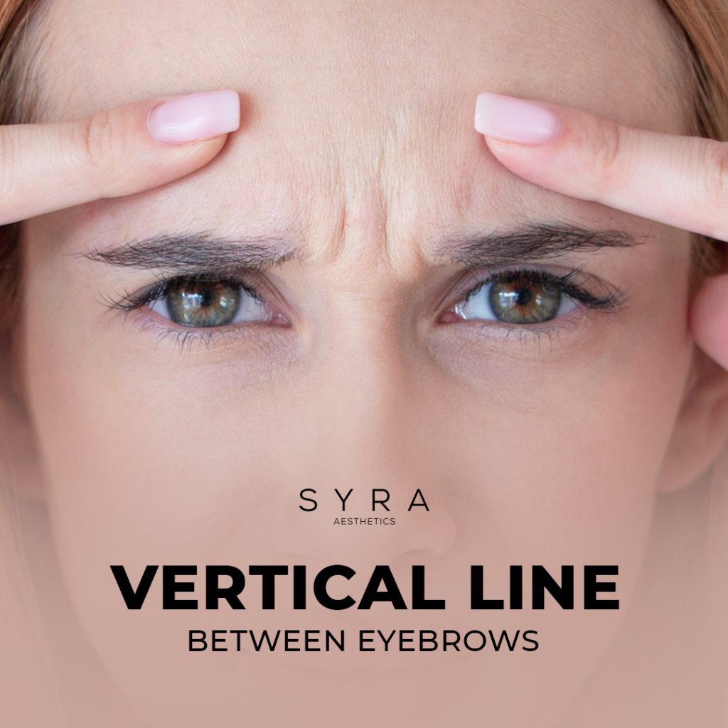 Key Facts About Vertical Line Between Eyebrows