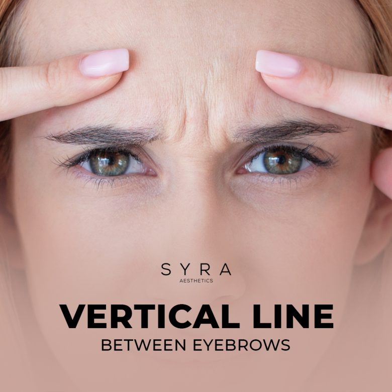 Vertical Line Between Eyebrows