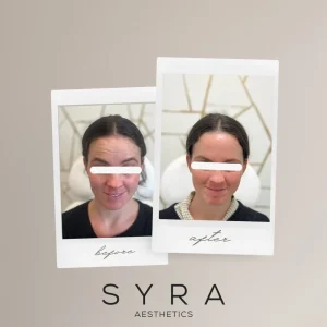 20-units-of-botox-before-and-after-1024x1024