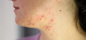 Acne on Neck