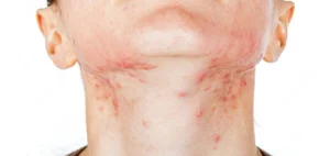 acne-on-neck