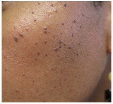 papules-on-neck