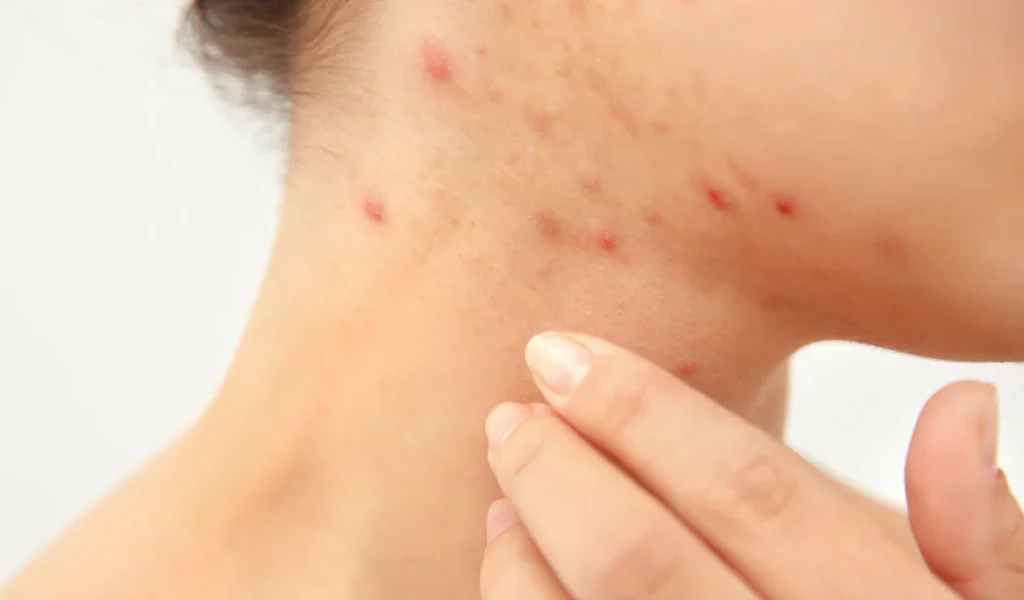 pustules-on-neck
