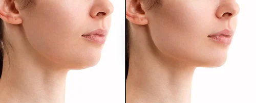 1ml-cheek-filler-before-and-after