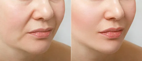 2ml-cheek-filler-before-and-after