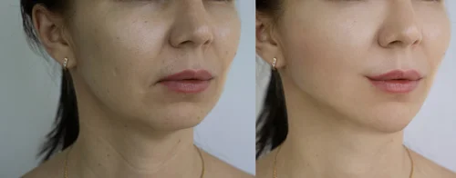 4ml-cheek-filler-before-and-after